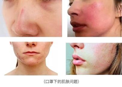 如何解决"口罩脸"出现的肌肤问题?